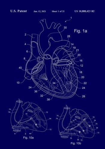 IMPRESSION DE BREVET DE COEUR : Illustration de plan médical - 7 x 5" - Bleu