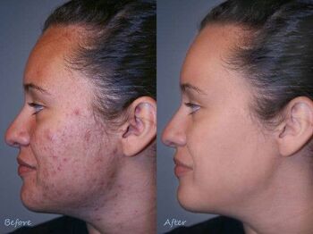 Huile naturelle d'acné et d'hyperpigmentation (Tamanu + Acai Oil) 3