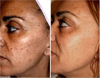Huile naturelle d'acné et d'hyperpigmentation (Tamanu + Acai Oil) 4