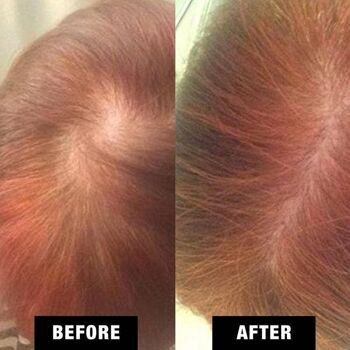 Croissance naturelle des cheveux et réparation du cuir chevelu (pelade) 2