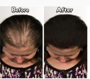 Croissance naturelle des cheveux et réparation du cuir chevelu (pelade) 3
