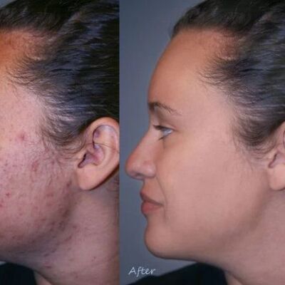 Natural Pimples and Acne Cream (With Salicylic Acid)