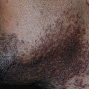Sérum naturel contre les bosses du rasoir et les poils incarnés