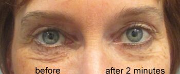 SUPREME DIRECT EYE LIFT - lifting instantané des yeux - résultats en 2 minutes 2